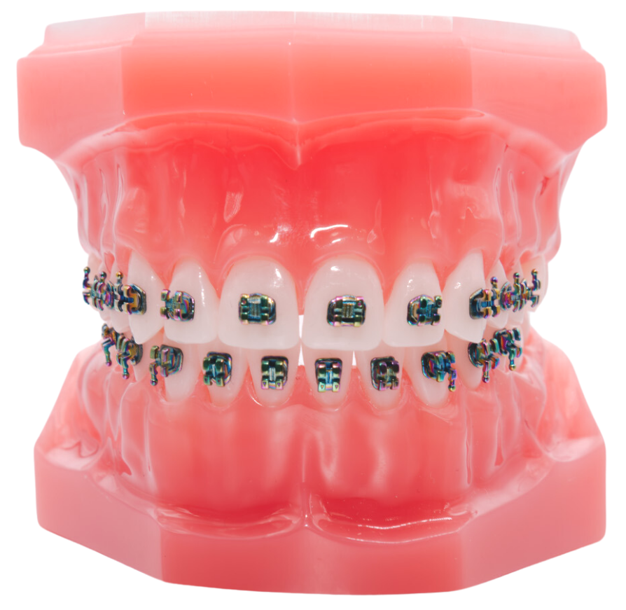 Imagine offers exclusive colored brackets on our braces, including galaxy, black, blue, and champagne.